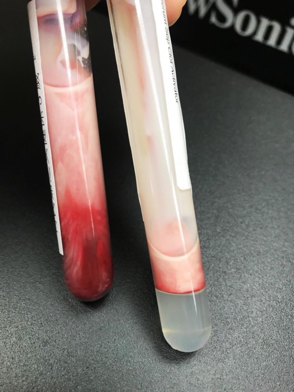 抽血竟然像煉乳？從北榮「萬級 TG」案例看遺傳性高三酸甘油酯症