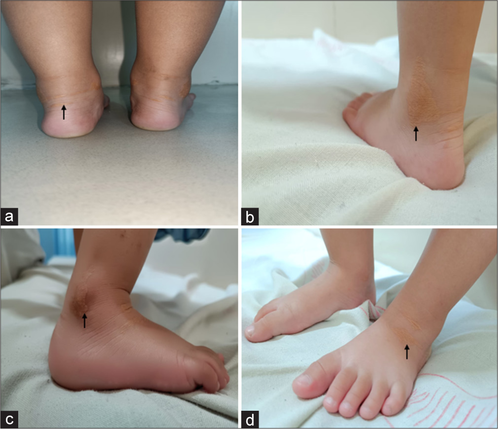 幼童關節長出「黃色瘤」?當心罕見基因變異——豆固醇血症 (Sitosterolemia) 與 ABCG5 基因解析